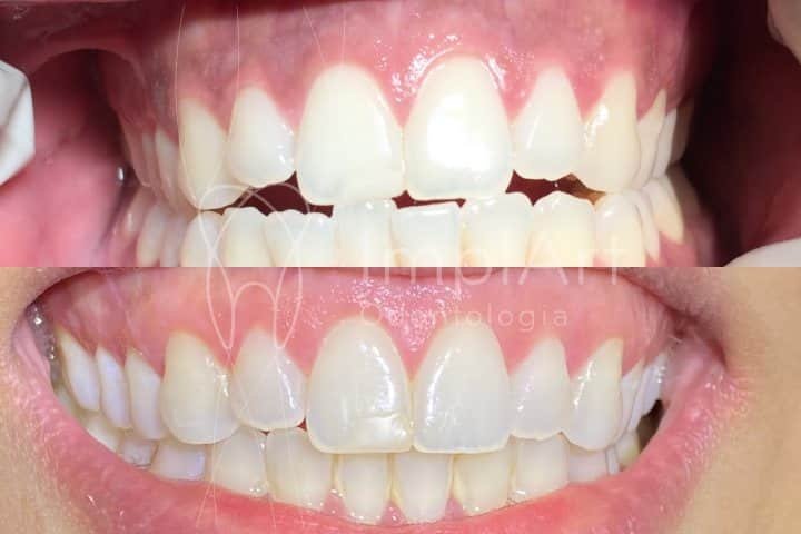 Antes e depois Invisalign