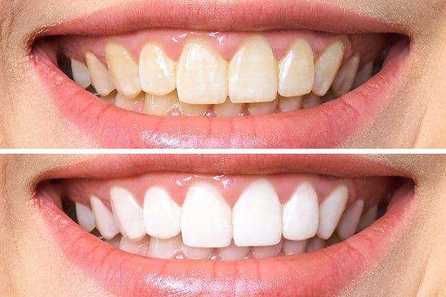 Antes e depois de Clareamento Dental