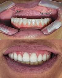 Antes e depois de Implantes Dentários