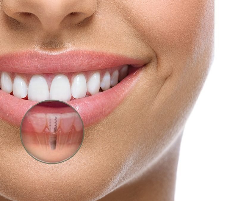 Implantes Dentários